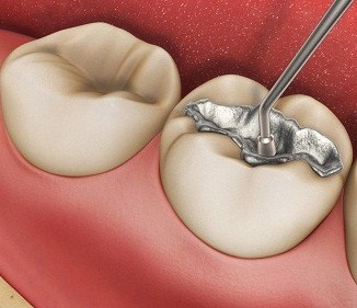 Hàn răng nhiều lần với Amalgam và hậu quả khôn lường