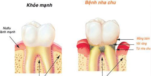 TỔNG QUÁT VỀ BỆNH NHA CHU