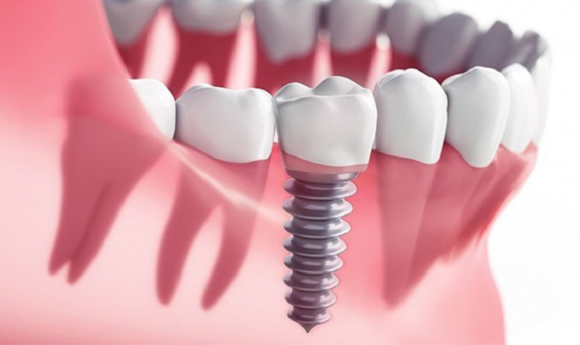 BIẾN CHỨNG IMPLANT: NHẬN BIẾT SỚM - XỬ LÝ KỊP THỜI - NGĂN NGỪA HIỆU QUẢ